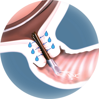 Dehydration of cervical tissue