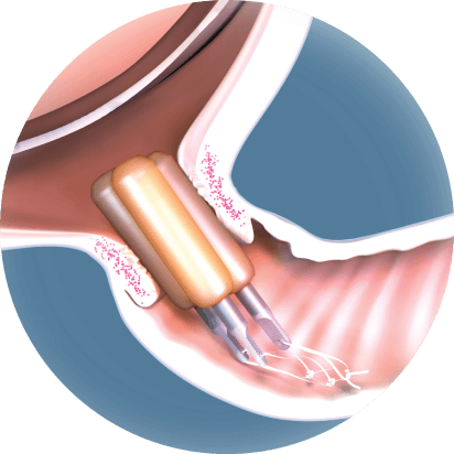 Prostaglandin release and collagen reorganization